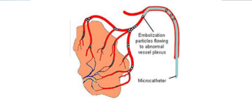 Carotid Stenting